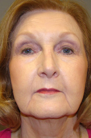 Dermal Fillers & Injectables Before and After Pictures Savannah, GA