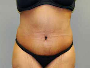 Tummy Tuck Before and After Pictures Savannah, GA