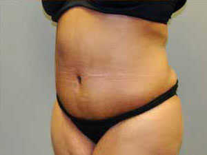 Tummy Tuck Before and After Pictures Savannah, GA