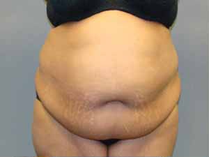 Tummy Tuck Before and After Pictures Savannah, GA