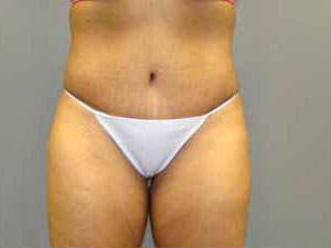 Tummy Tuck Before and After Pictures Savannah, GA