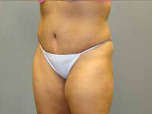 Tummy Tuck Before and After Pictures Savannah, GA