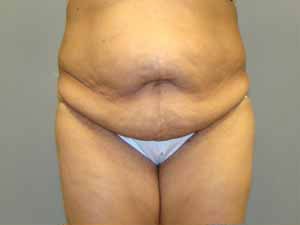 Tummy Tuck Before and After Pictures Savannah, GA