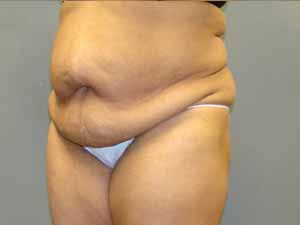 Tummy Tuck Before and After Pictures Savannah, GA
