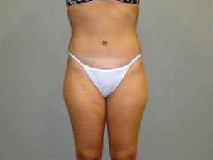 Tummy Tuck Before and After Pictures Savannah, GA