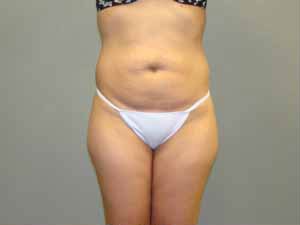 Tummy Tuck Before and After Pictures Savannah, GA