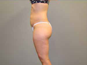 Tummy Tuck Before and After Pictures Savannah, GA