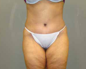 Tummy Tuck Before and After Pictures Savannah, GA