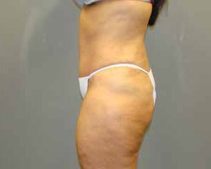 Tummy Tuck Before and After Pictures Savannah, GA