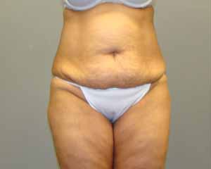 Tummy Tuck Before and After Pictures Savannah, GA
