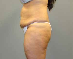 Tummy Tuck Before and After Pictures Savannah, GA
