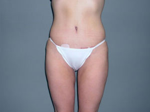 Tummy Tuck Before and After Pictures Savannah, GA