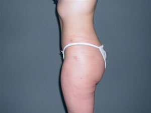 Tummy Tuck Before and After Pictures Savannah, GA