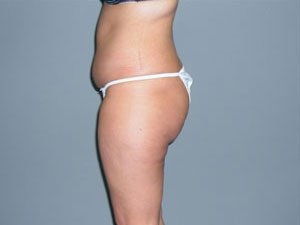 Tummy Tuck Before and After Pictures Savannah, GA