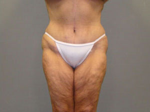 Tummy Tuck Before and After Pictures Savannah, GA