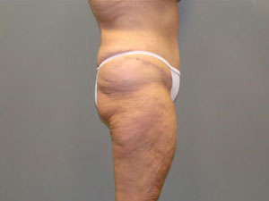 Tummy Tuck Before and After Pictures Savannah, GA