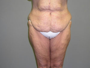 Tummy Tuck Before and After Pictures Savannah, GA