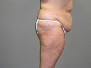 Tummy Tuck Before and After Pictures Savannah, GA