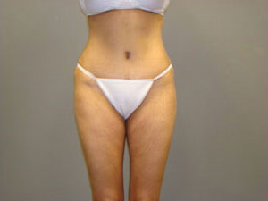 Tummy Tuck Before and After Pictures Savannah, GA