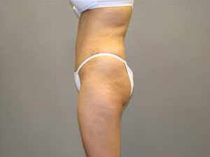Tummy Tuck Before and After Pictures Savannah, GA