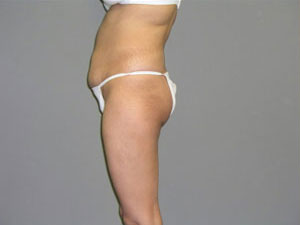 Tummy Tuck Before and After Pictures Savannah, GA