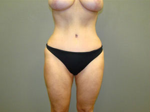 Tummy Tuck Before and After Pictures Savannah, GA