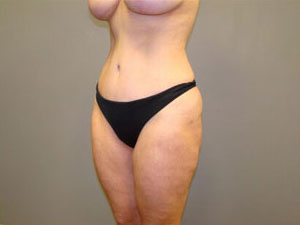 Tummy Tuck Before and After Pictures Savannah, GA
