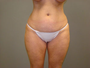Tummy Tuck Before and After Pictures Savannah, GA