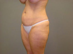 Tummy Tuck Before and After Pictures Savannah, GA