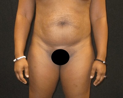 Tummy Tuck Aug11 Before 1