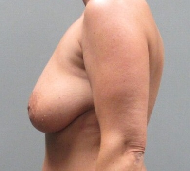 Breast Augmentation and Breast Lift (Mastopexy) before