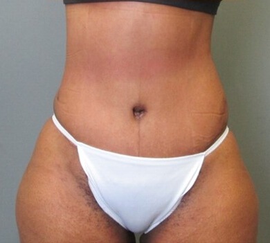 Tummy Tuck and Liposuction after