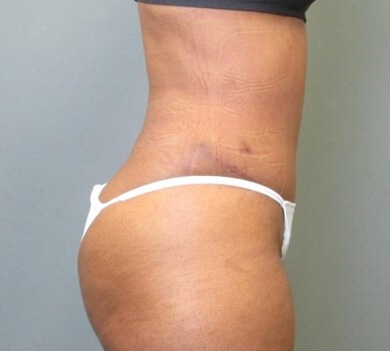 Tummy Tuck and Liposuction after