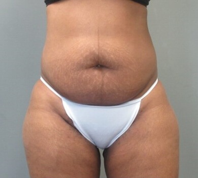 Tummy Tuck and Liposuction before