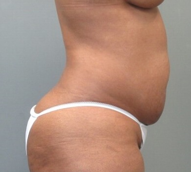 Tummy Tuck and Liposuction before