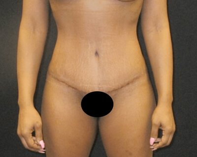 Tummy Tuck Aug11 After 1