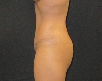 Tummy Tuck Aug11 After 3