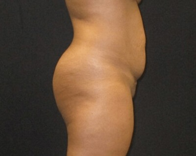 Tummy Tuck Aug11 Before 3