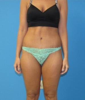 Tummy Tuck