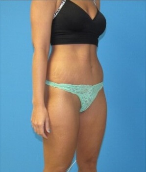 Tummy Tuck