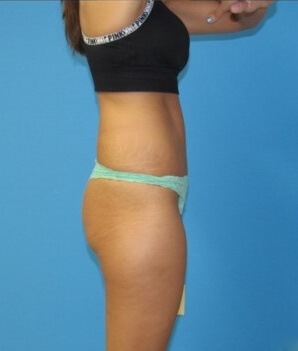 Tummy Tuck