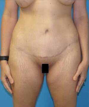 Tummy Tuck Case 35 after
