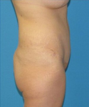 Tummy Tuck Case 35 after
