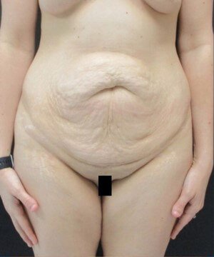 Tummy Tuck Case 35 before