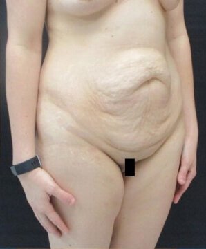Tummy Tuck Case 35 before