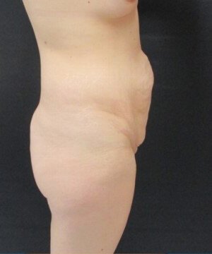 Tummy Tuck Case 35 before