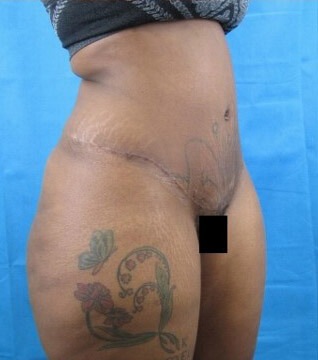 Liposuction Case 21