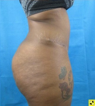 Liposuction Case 21