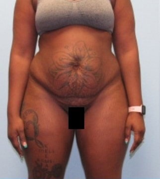 Liposuction Case 21