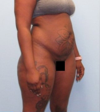 Liposuction Case 21